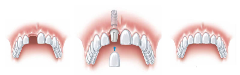 https://www.stephenfranks.dental/wp-content/uploads/2016/07/implant-single.jpg